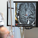 Navigierte Transkranielle Magnetstimulation(nTMS)-neurochirurgische Untersuchungsmethode